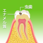 Ｃ１（エナメル質の虫歯）