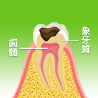 Ｃ２（象牙質の虫歯）