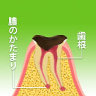Ｃ４（末期状態の虫歯）