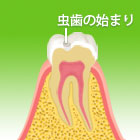 Ｃ０（初期虫歯）