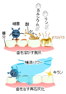 脱灰と再石灰化