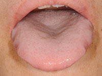 舌圧痕 症例２