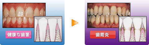 歯周病