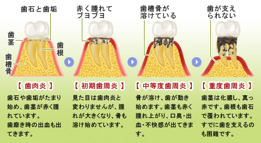 歯周病の進行図