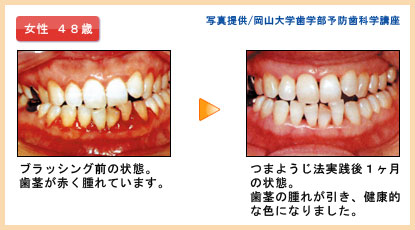 つまようじ法症例