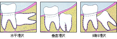 親知らず