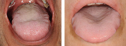 舌圧痕 症例