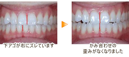 かみ合わせの改善