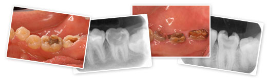 虫歯治療の状態