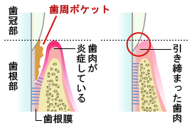 歯周ポケット