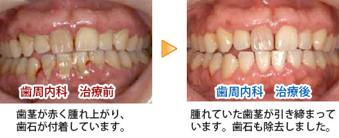 歯周内科の治療前と治療後の症例