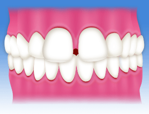 すきっ歯・空隙歯列